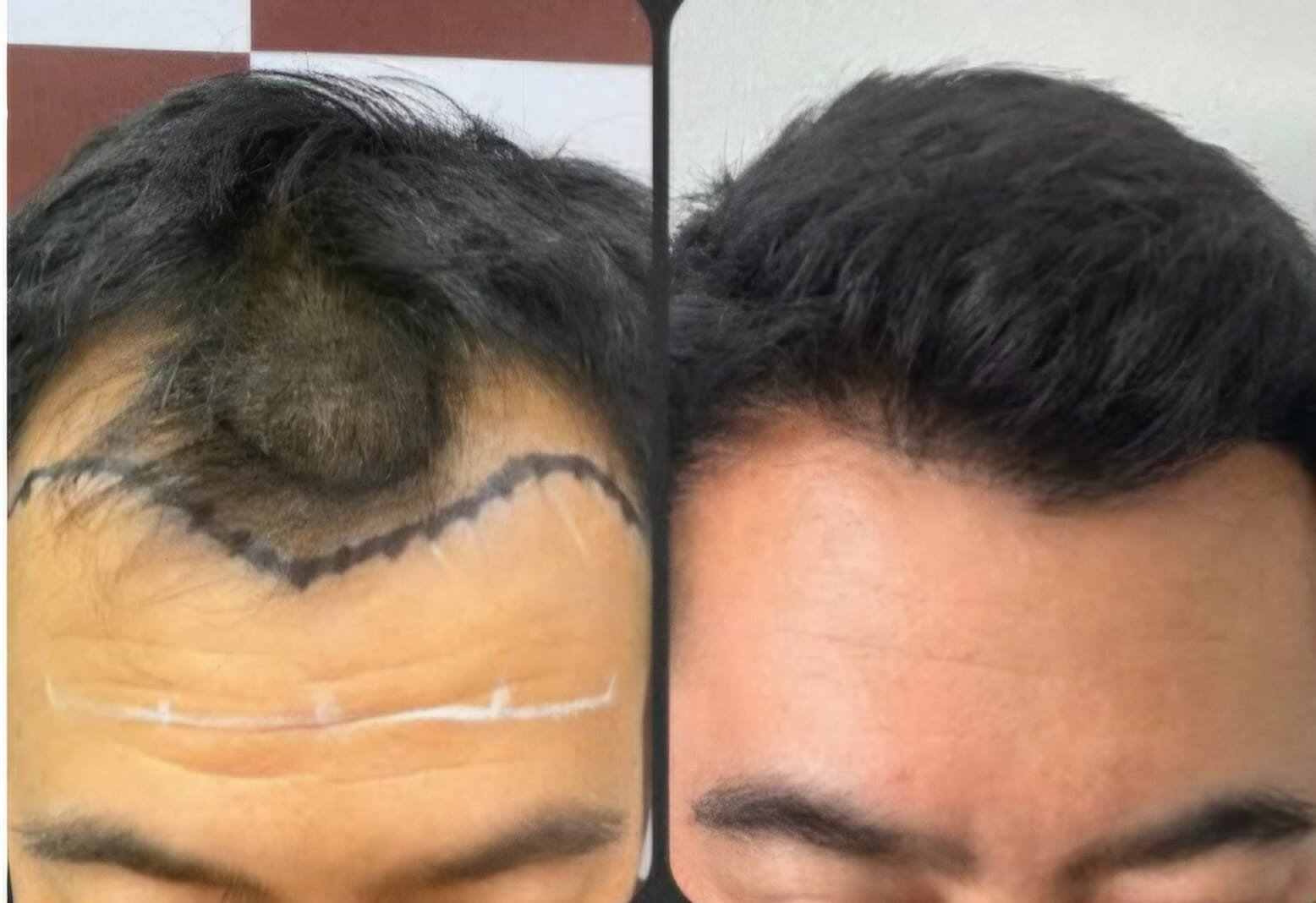 Marcação da linha frontal desenhada à mão antes da cirurgia, ao lado do resultado